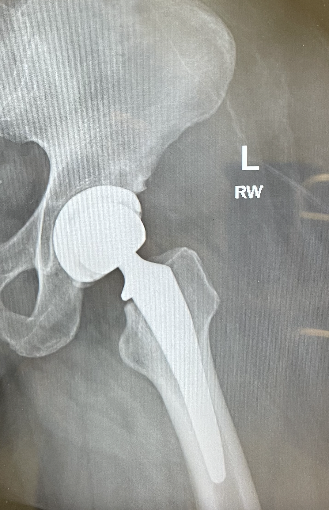 hip-replacement-xray